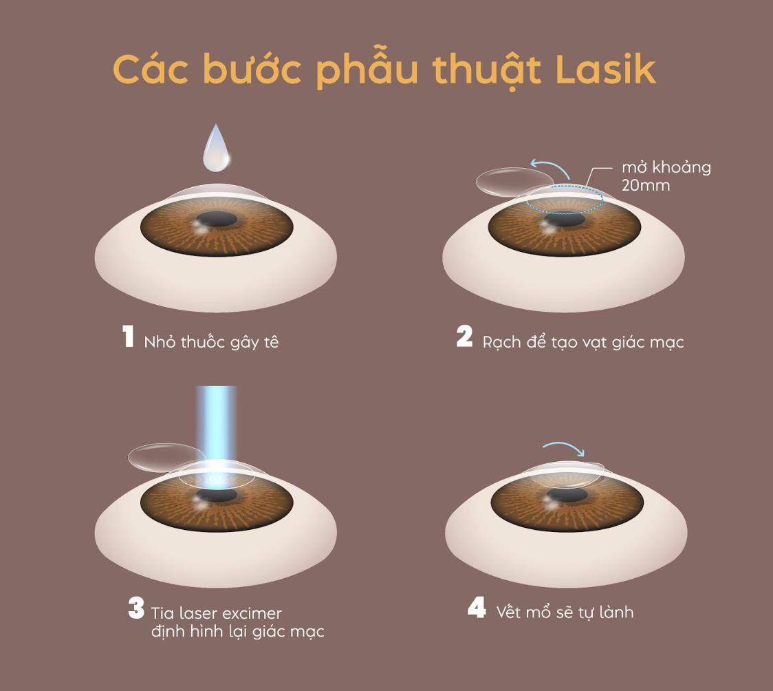 Các bước phẫu thuật Lasik