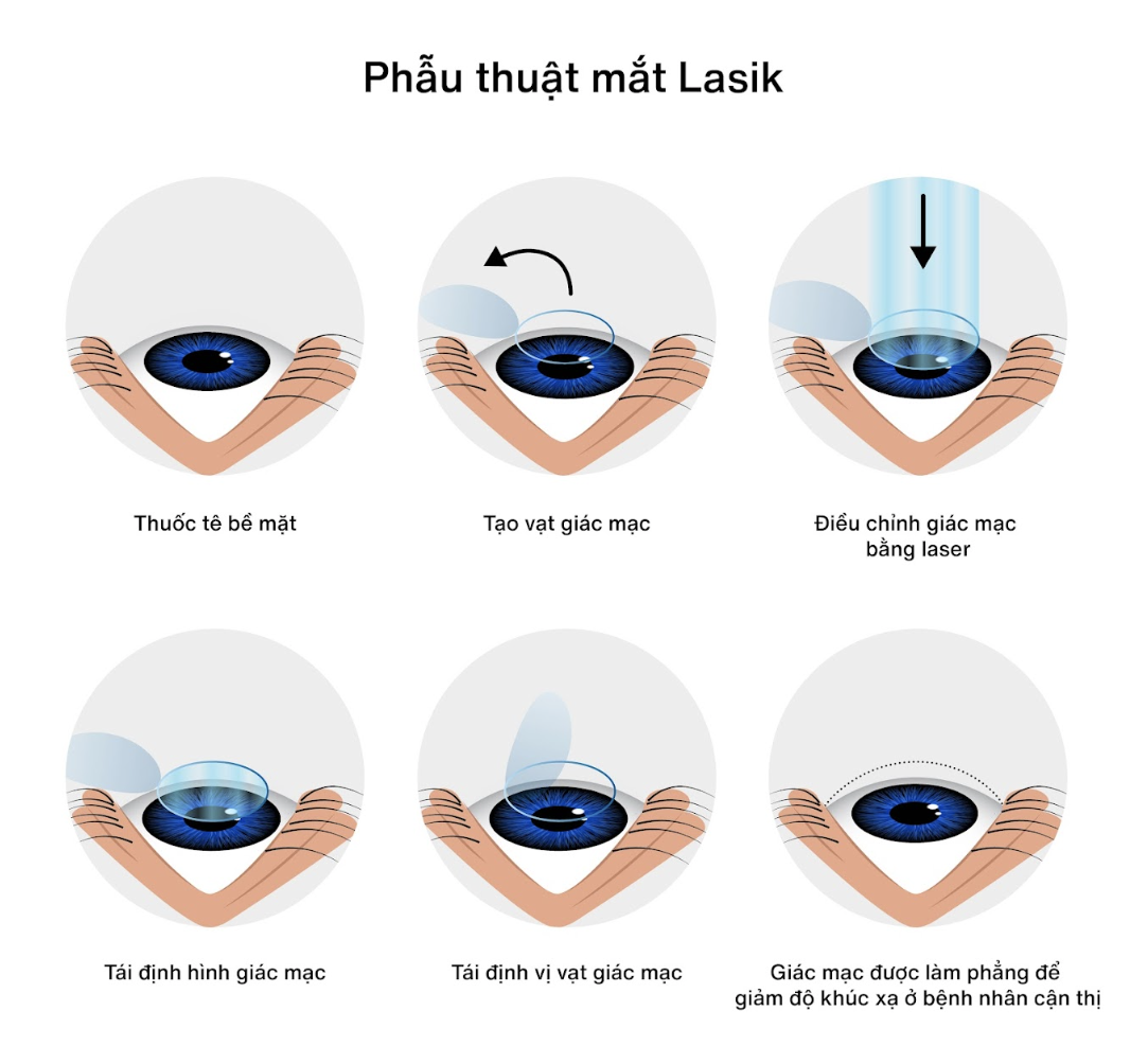 Phẫu thuật mắt Lasik